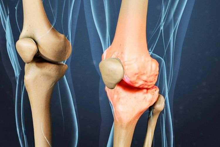Your Knee Cartilage Cannot Heal Itself